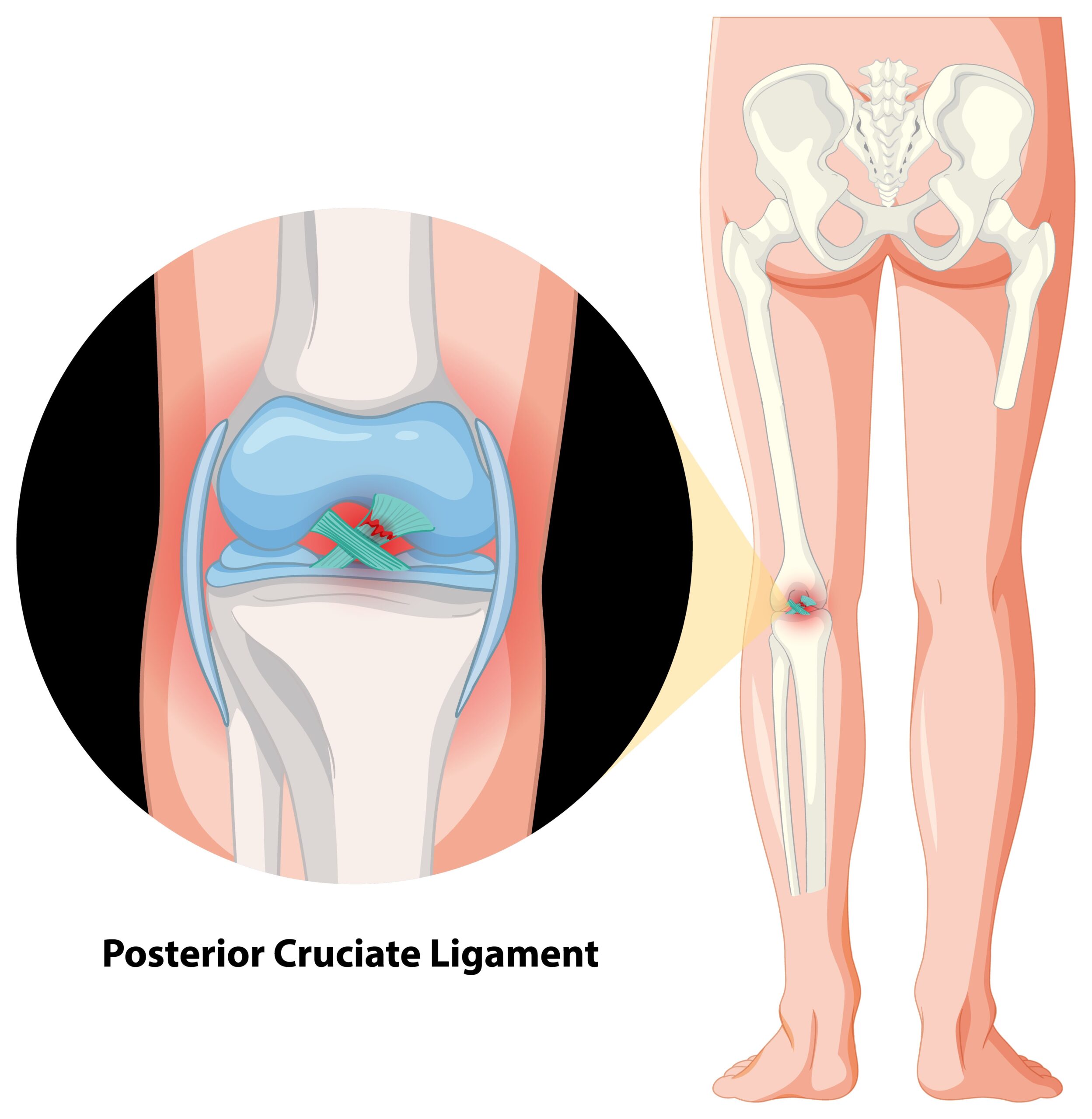 torn meniscus symptoms
