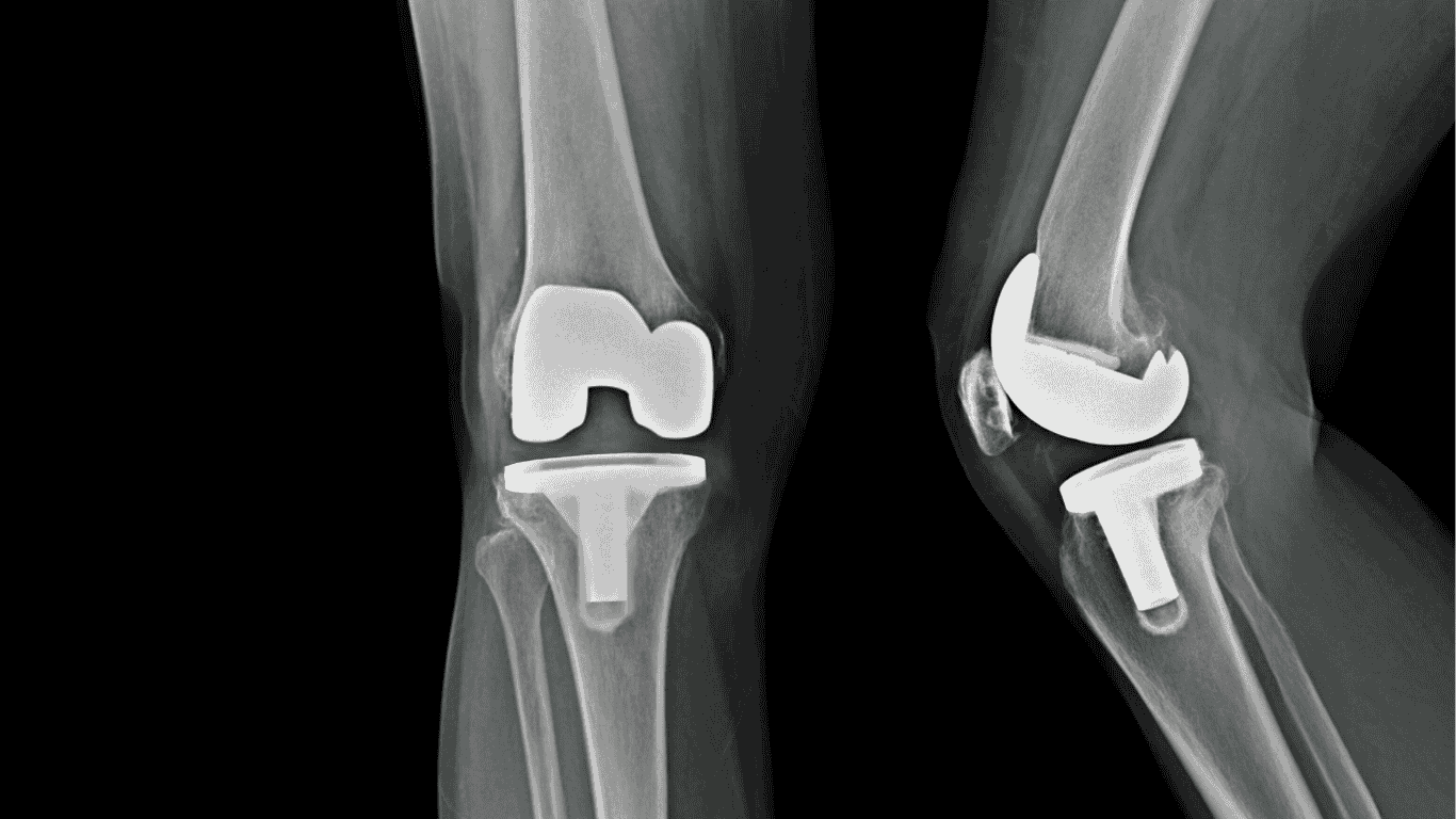 علاج التورم والألم بعد تغيير مفصل الركبة